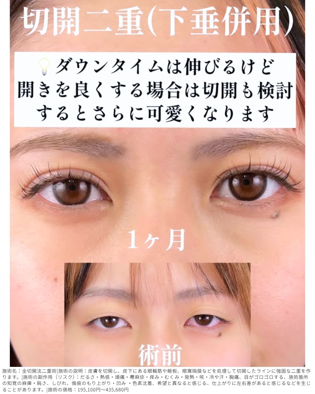 全切開二重術