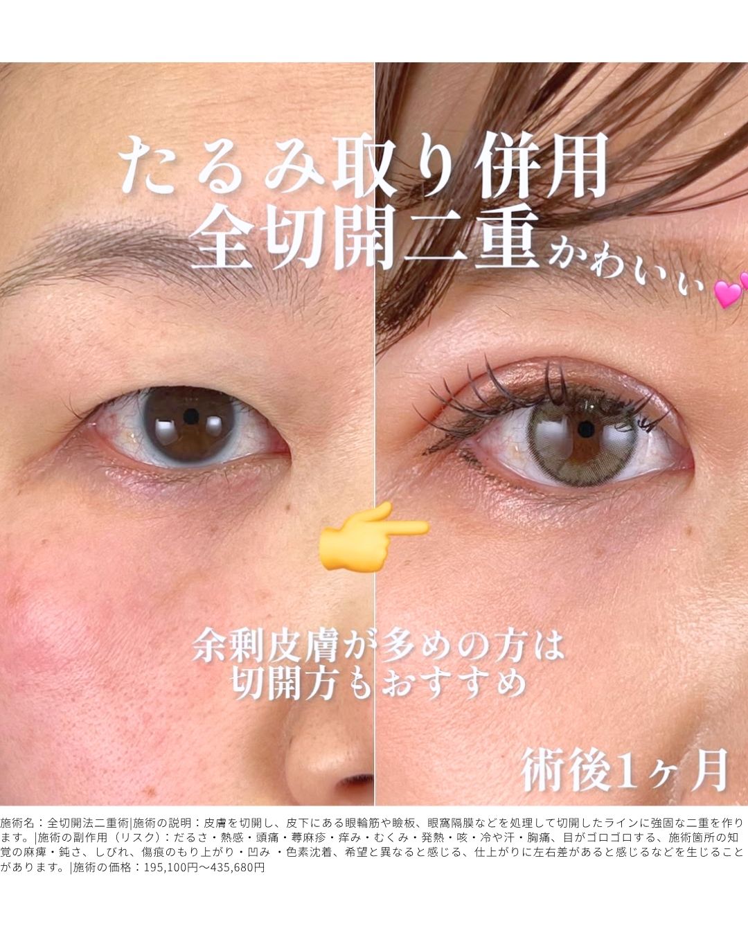 たるみ取り併用全切開二重術