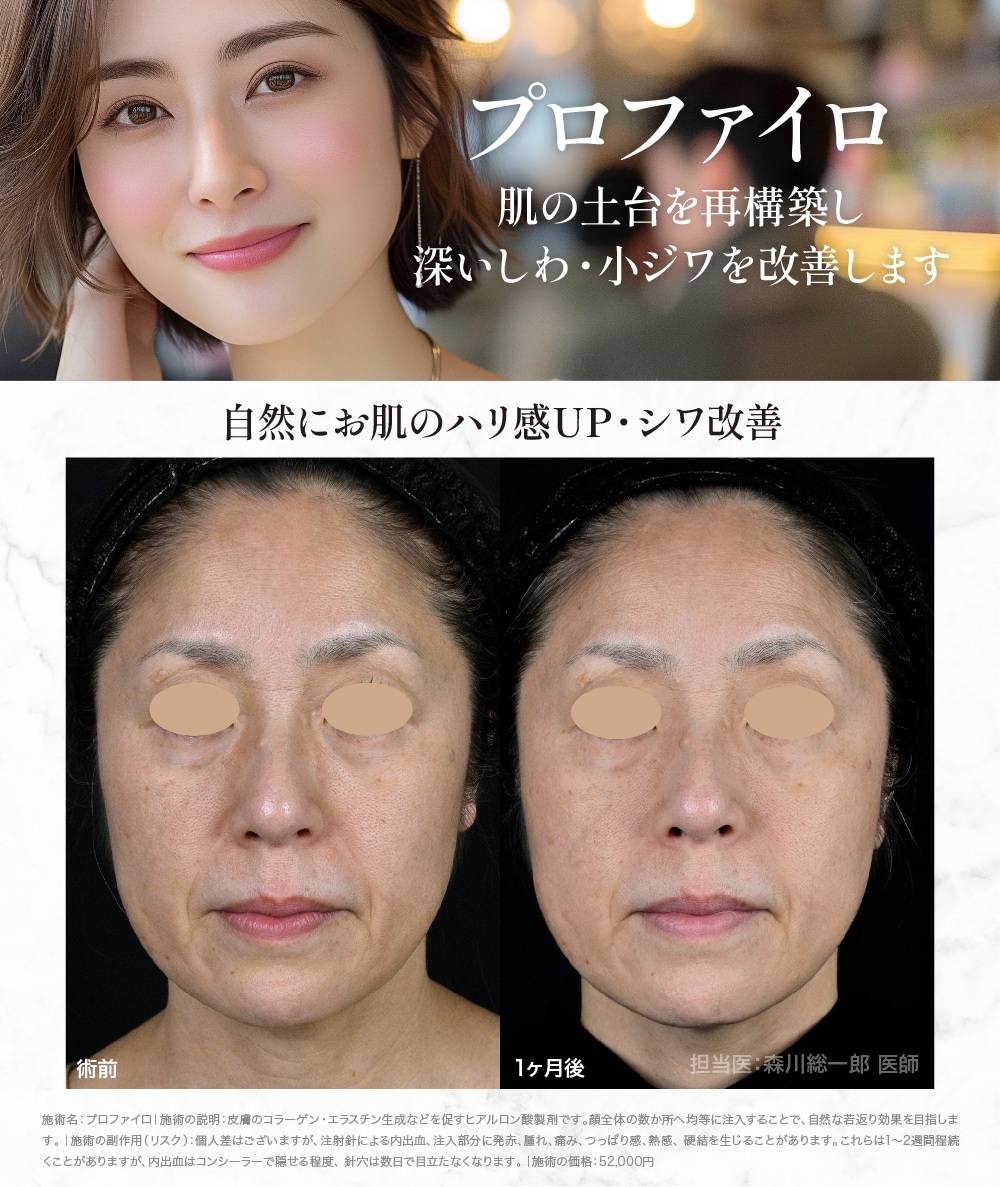 プロファイロ