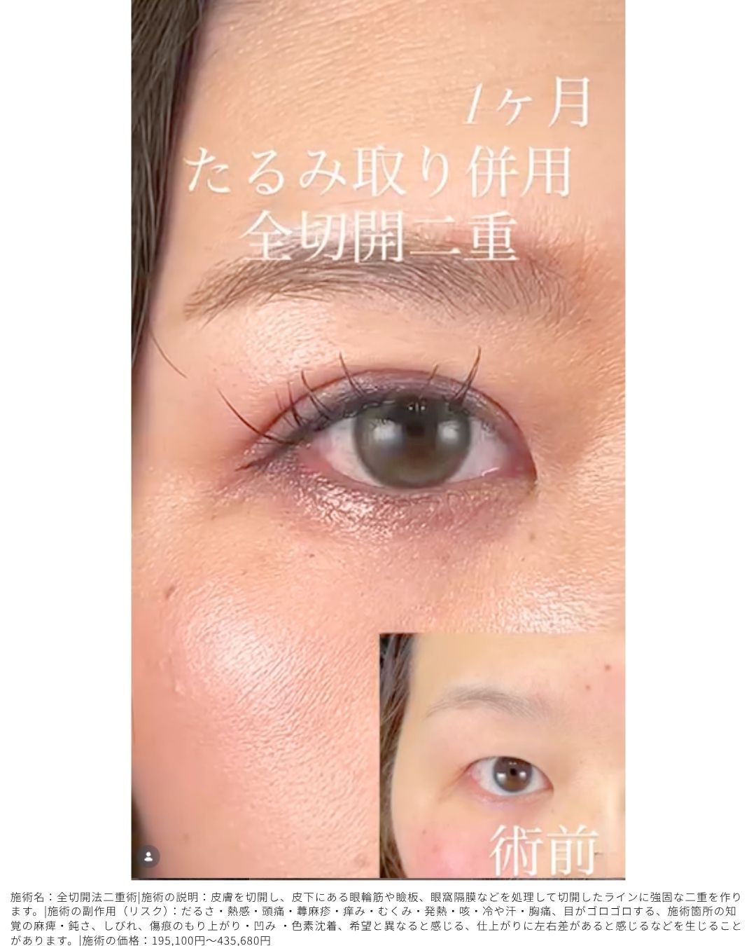 たるみ取り併用全切開二重術