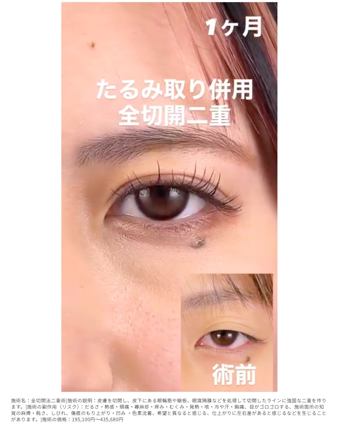 たるみ取り併用全切開二重術
