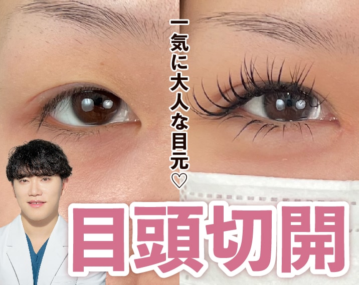 湘南美容クリニック熊本院の目頭切開で離れ目改善！