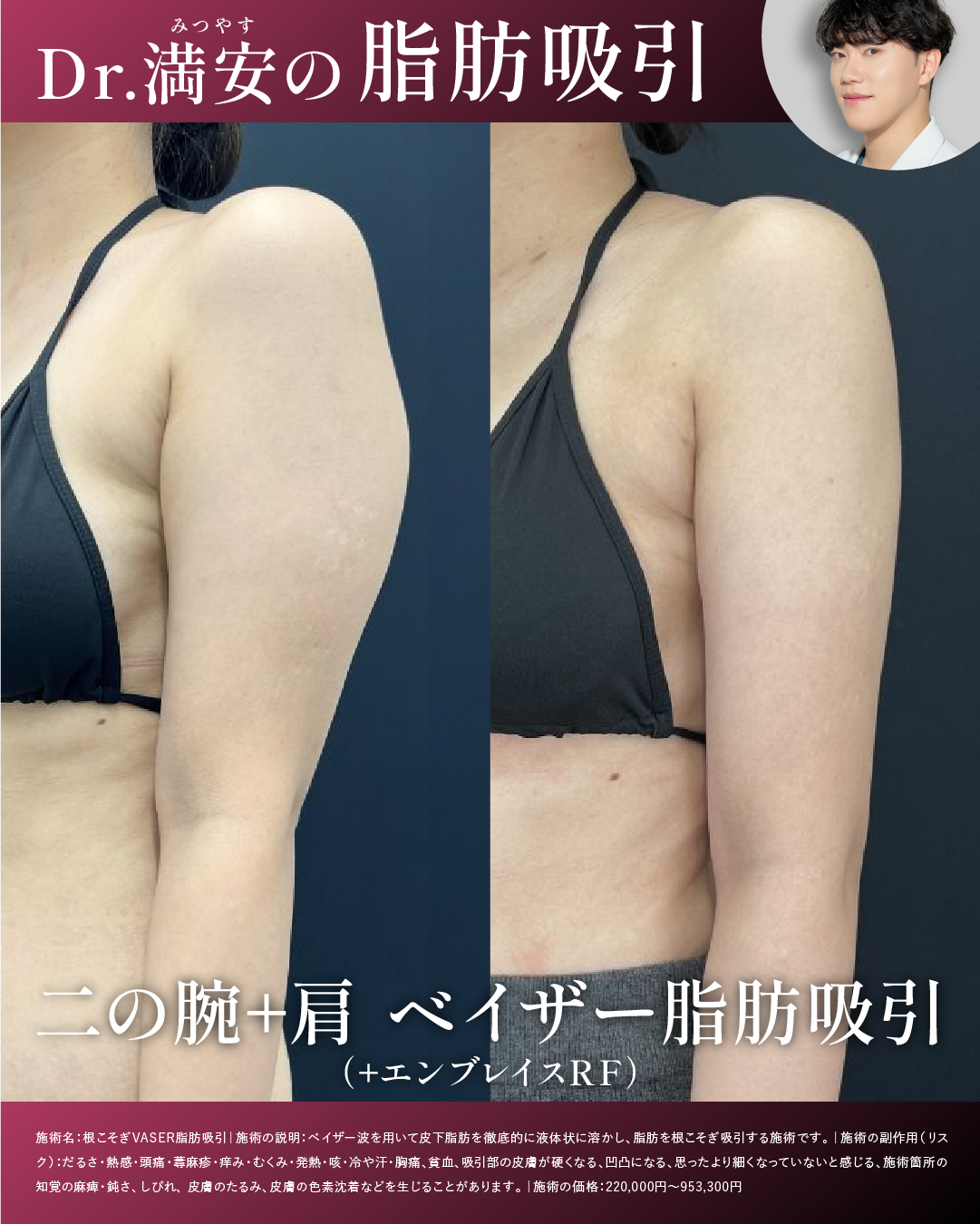ベイザー脂肪吸引（二の腕+肩）