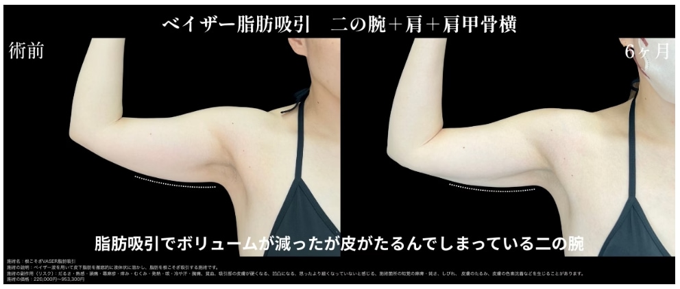 脂肪吸引のデメリット 皮膚の余りを解消
