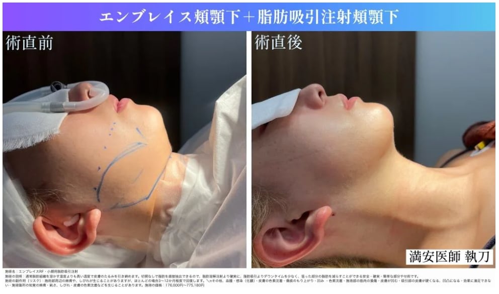 顎下ピタッと、美しいラインに
