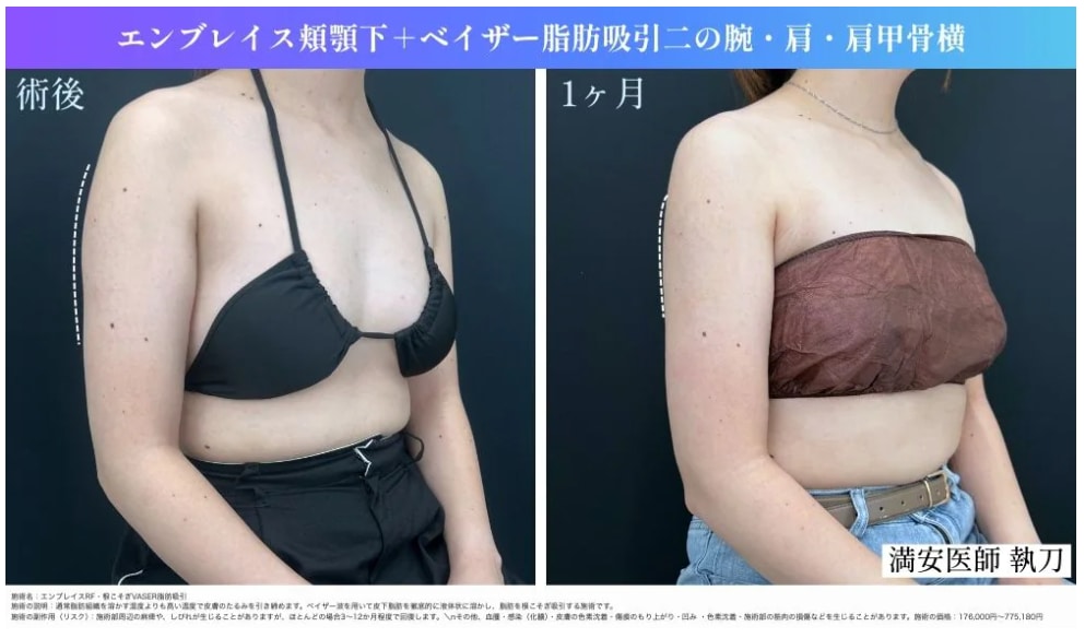 二の腕のたるみもスッキリ