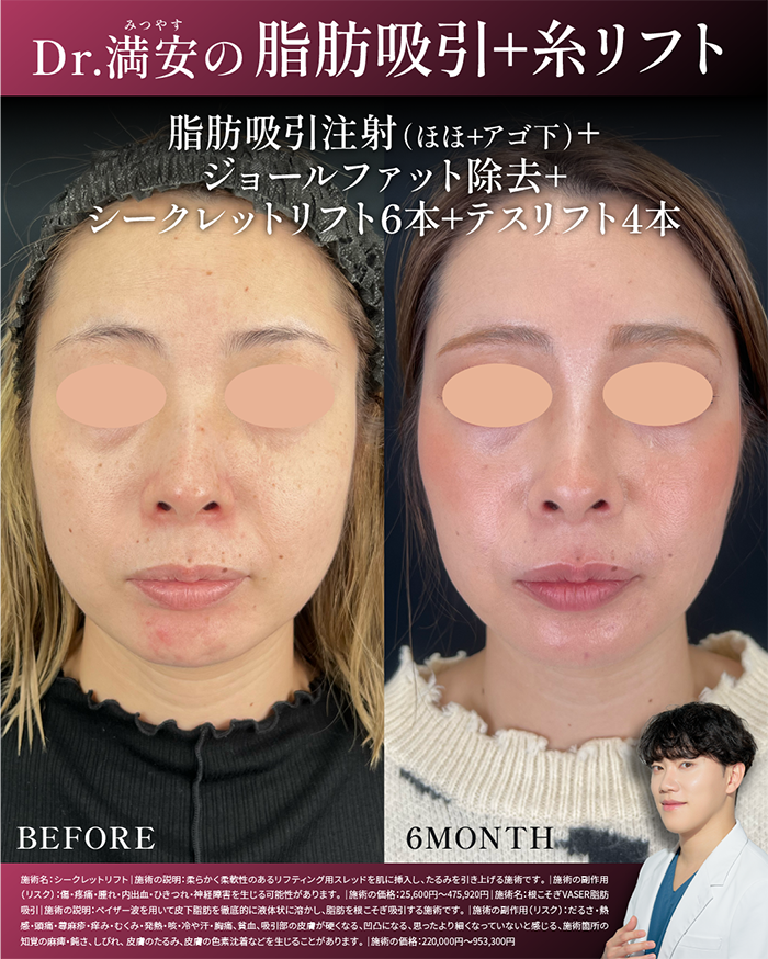 脂肪吸引とのセットでさらにお得！