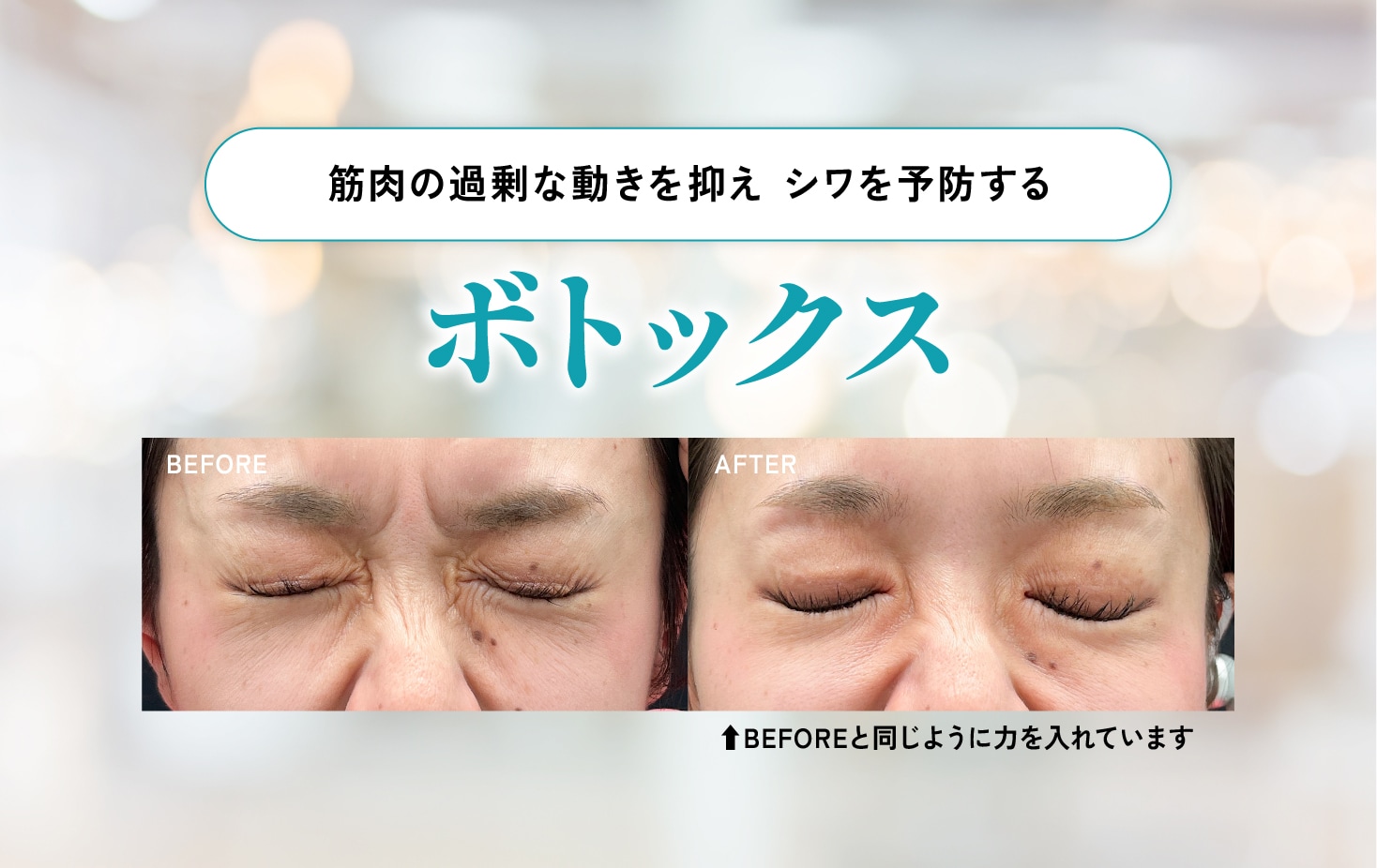 ボトックス注射