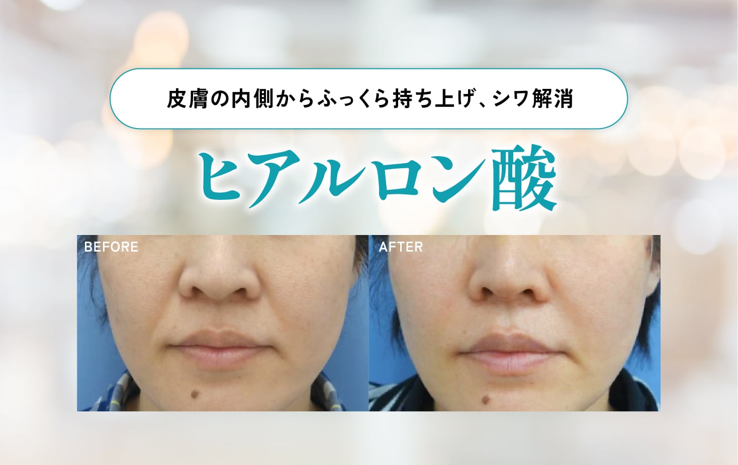 ヒアルロン酸注射