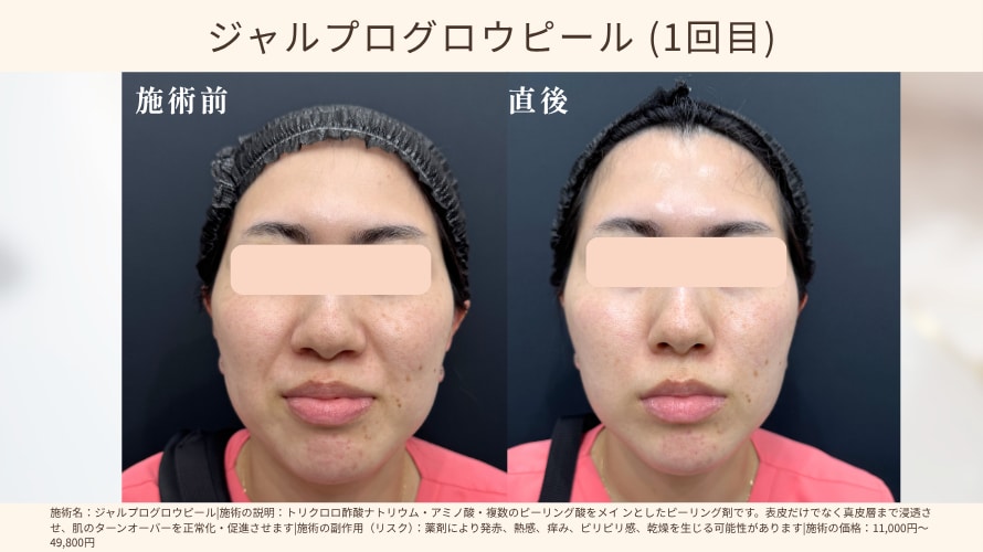 肌管理の基本として取り入れやすいピーリング