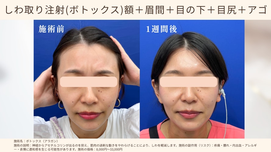 表情によるしわが気になる方へ「しわ取り注射（ボトックス）」