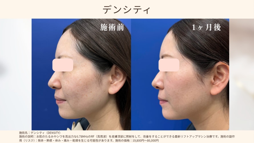 ハリ・たるみが気になる方へ「デンシティ」