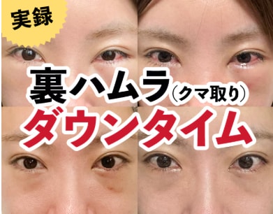 腫れや内出血には個人差があります