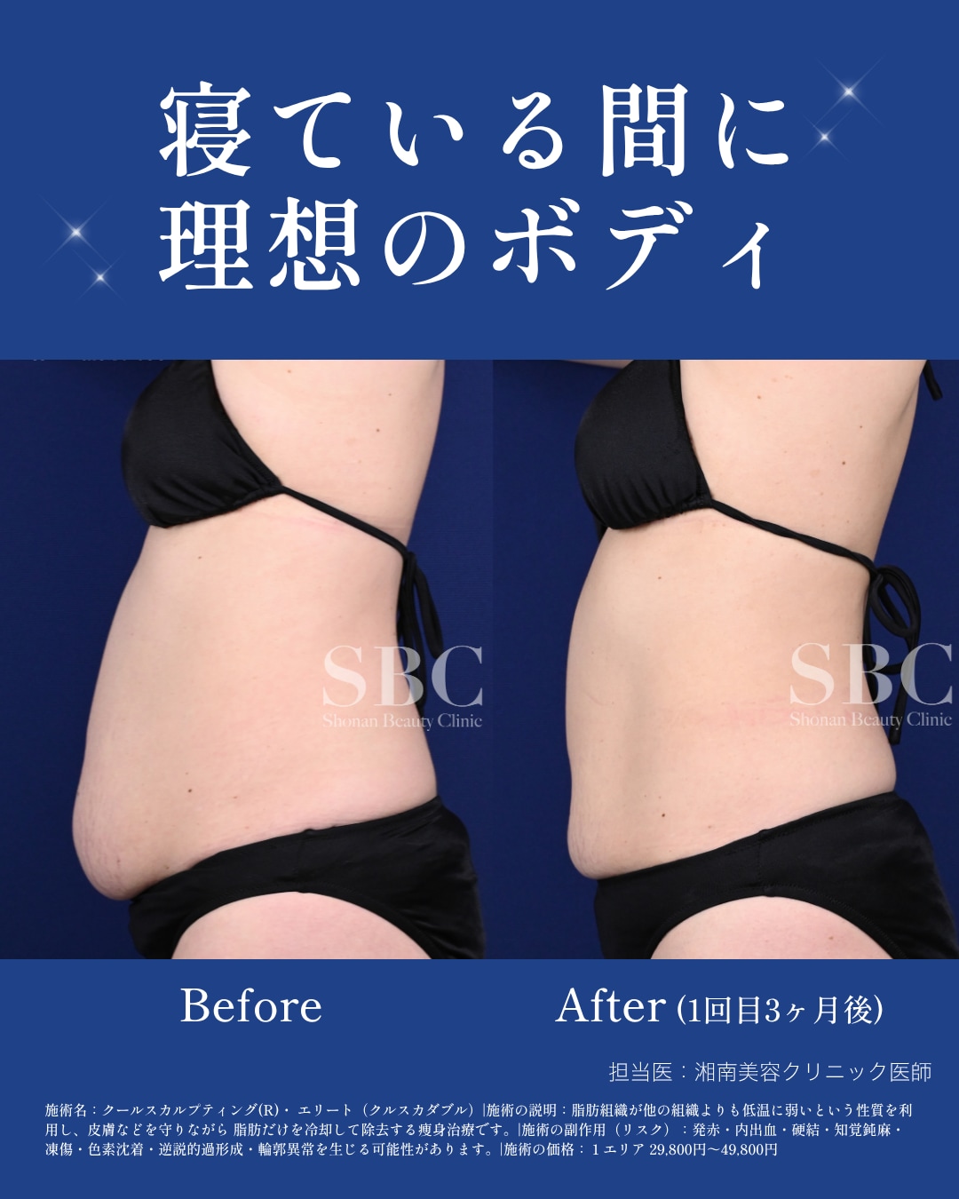 クールスカルプティング® エリート（クルスカダブル）