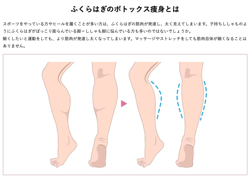 ボトックス痩身／ボツリヌストキシン痩身