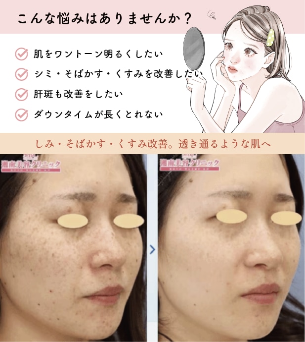ピコトーニング