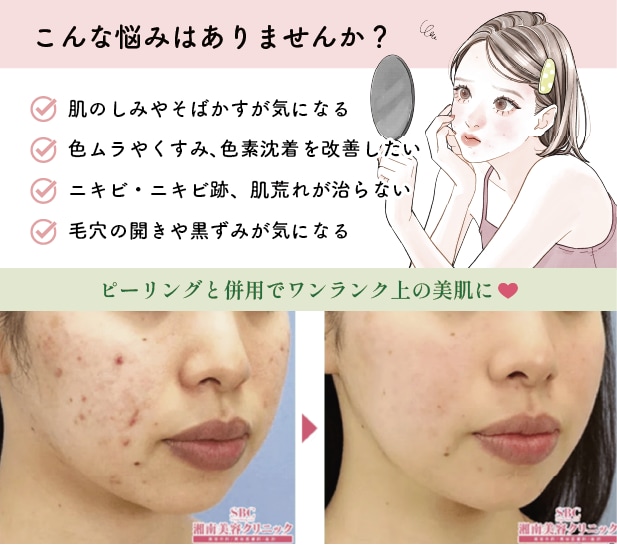 イオン導入