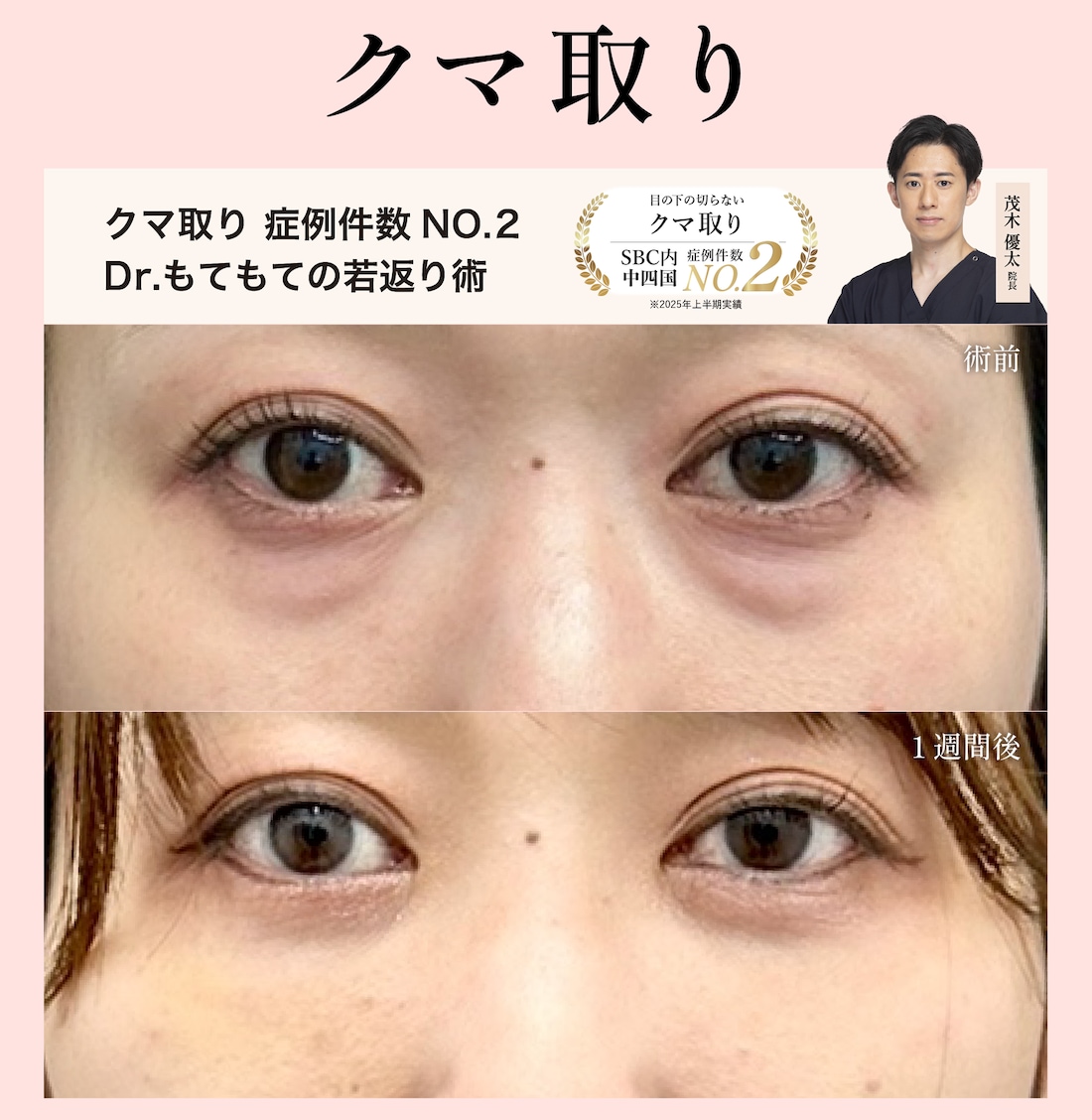 「クマ取り」モニター