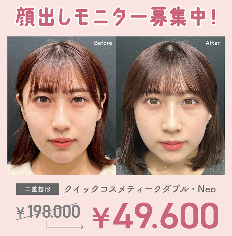 「二重整形/クイックコスメティークダブル・Neo」モニター