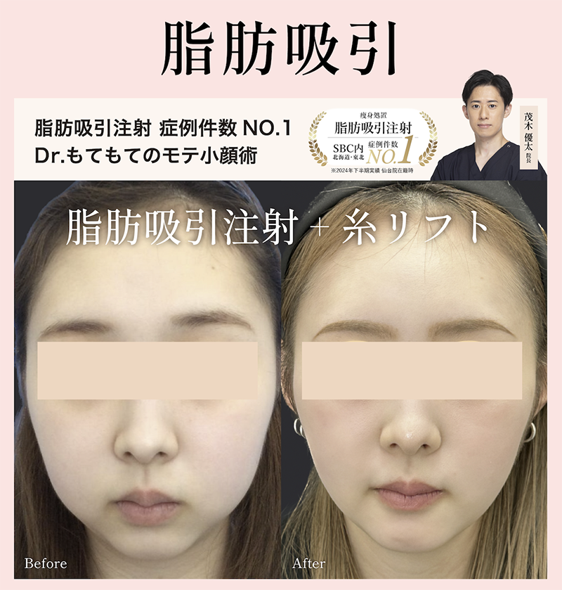 「脂肪吸引 / 脂肪吸引注射」モニター
