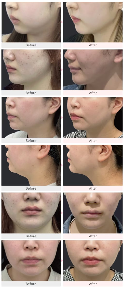 「脂肪吸引注射」症例件数 No.1※の茂木院長が在籍