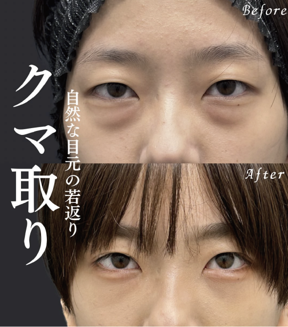 1位 / クマ取り・脂肪注入