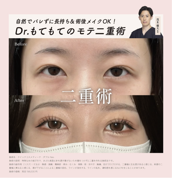 2位 / 二重整形・涙袋ヒアルロン酸