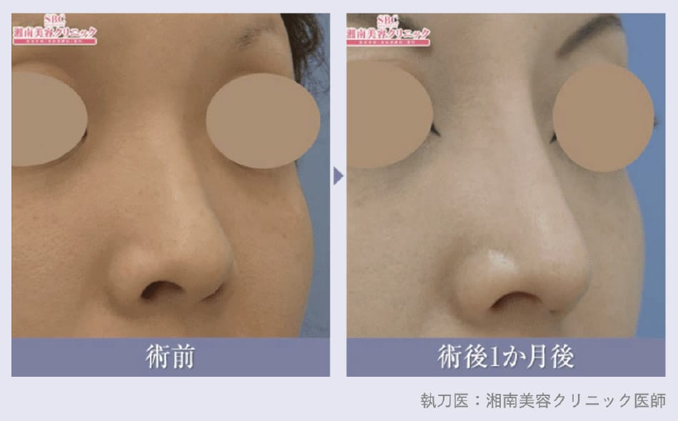 12月15日(月)岡山院「鼻整形/SBCプレミアムソフトプロテーゼ」モニター