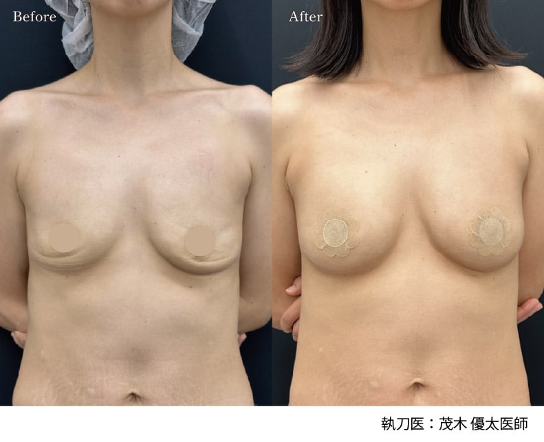 2026年1月14日(水)岡山院「脂肪注入豊胸/コンデンスリッチ脂肪注入豊胸」モニター