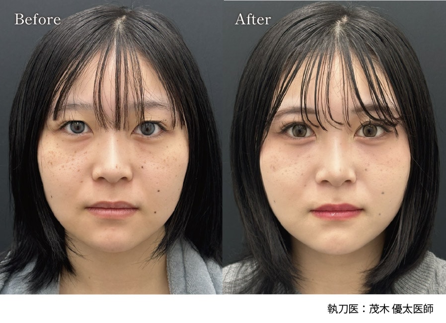 「クマ取り/目の下の切らないクマ取り」モニター