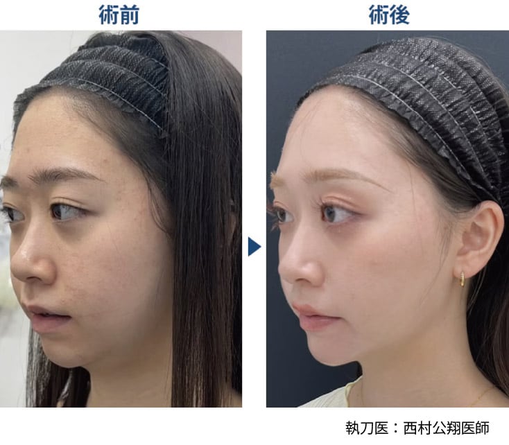 「脂肪吸引 / 脂肪吸引注射」モニター