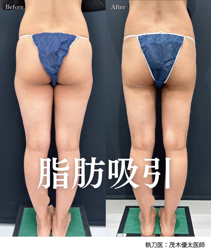 2026年1月14日(水)岡山院「根こそぎVASER脂肪吸引（大腿全体＋臀部＋膝）」モニター