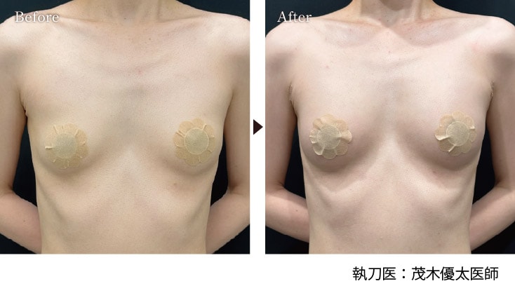 「豊胸 / 脂肪注入豊胸」モニター