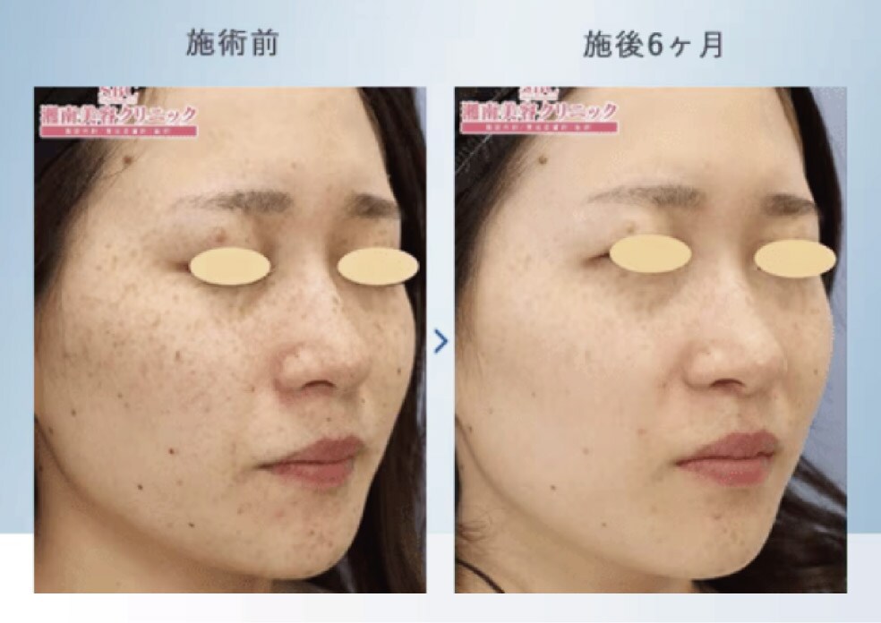 美容皮膚科 NO.1「ピコトーニング」