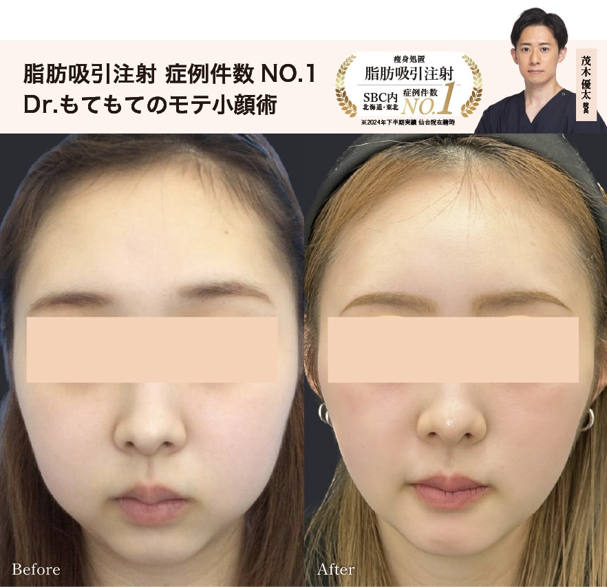 美容外科 NO.1「脂肪吸引」