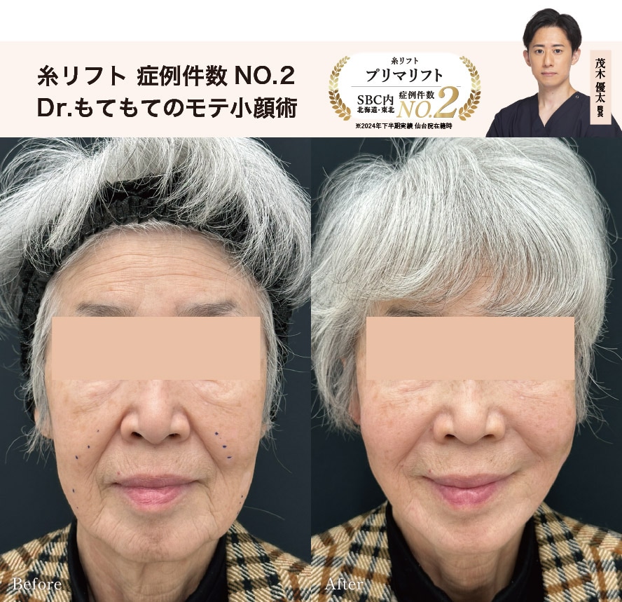 美容外科 NO.3「糸リフト」