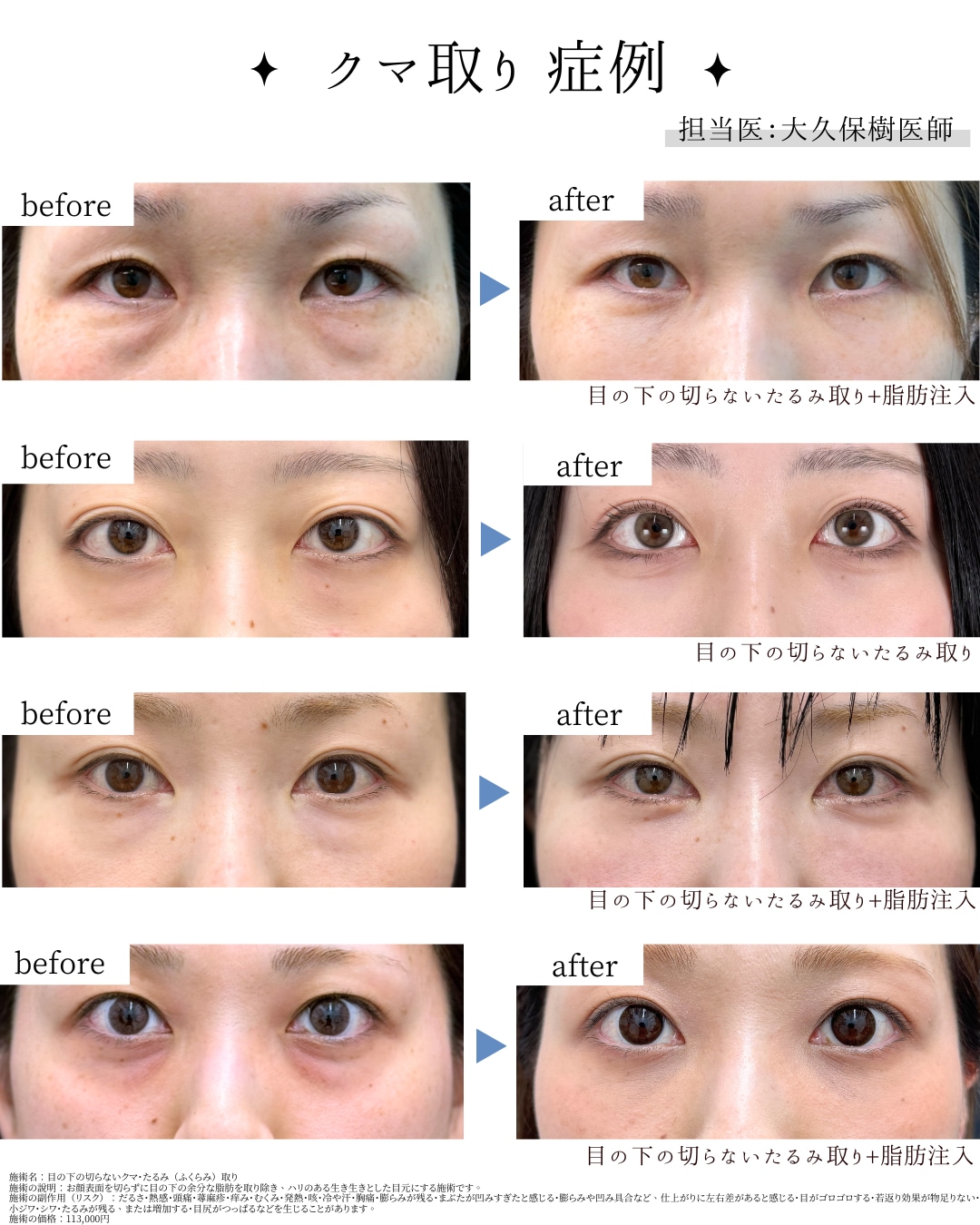 ナチュラルに変化する「切らないたるみ取り」