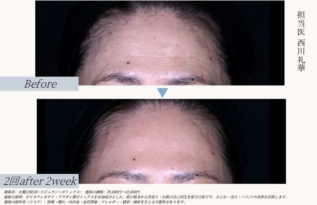 ②女優注射