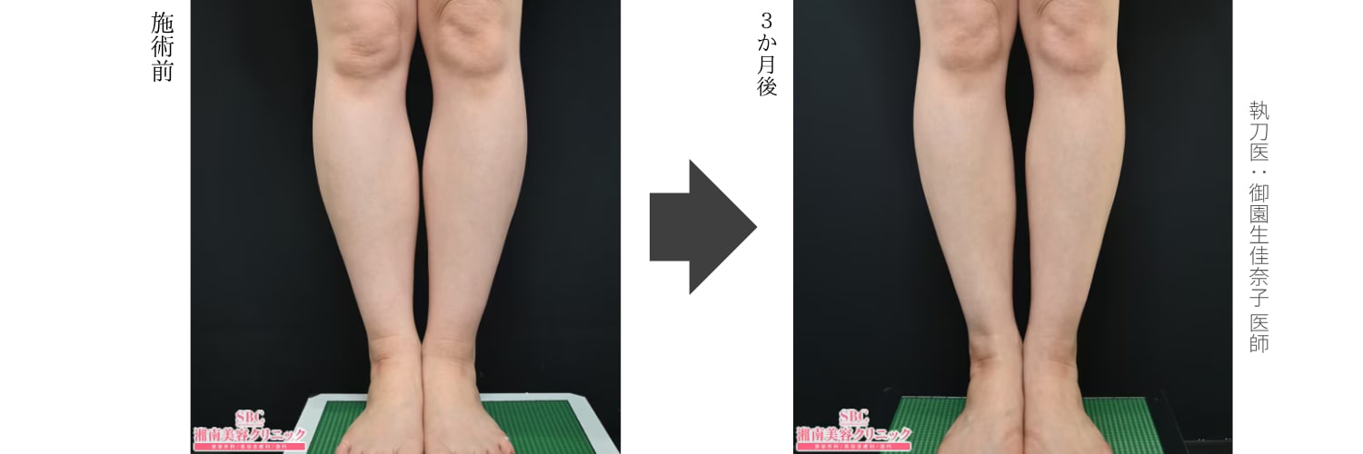 湘南美容クリニック ふくらはぎボトックスのキャンペーン画像