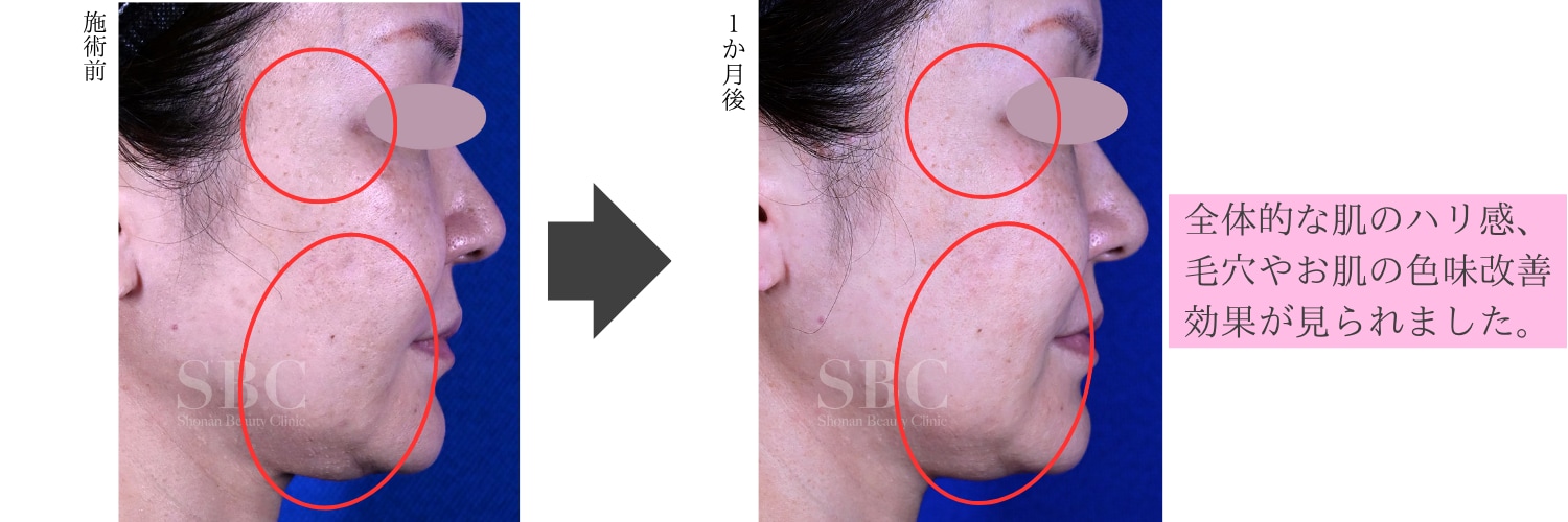 湘南美容クリニック ハイフシャワーのキャンペーン画像
