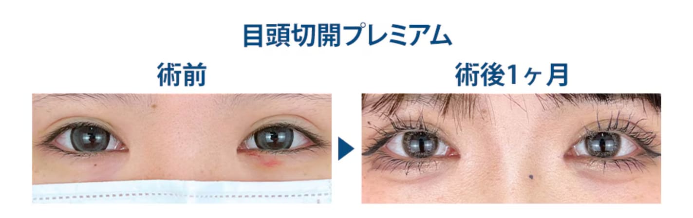 <h2>💎✨ もっと目を大きく!可愛さUP!自然癒着セット&目頭切開プレミアムで垢抜けアイをGETしよ!</h2>