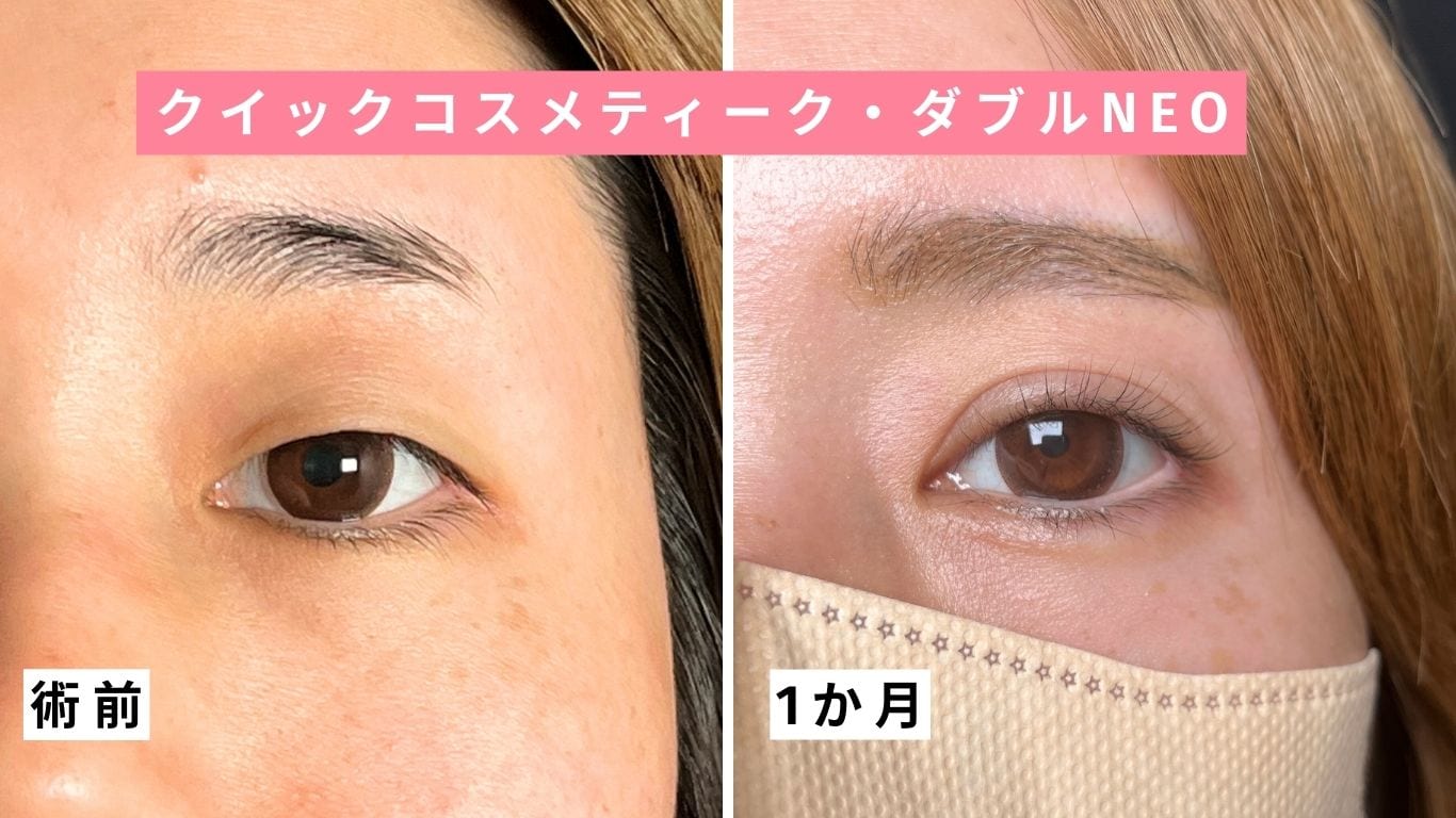 クイックコスメティーク・ダブルNeo 症例写真