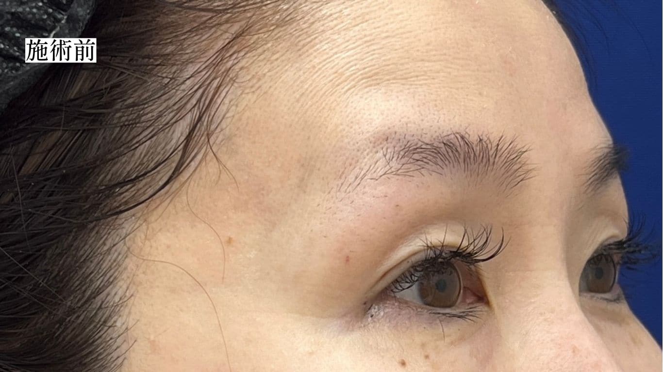 女優水光注射の施術イメージ写真