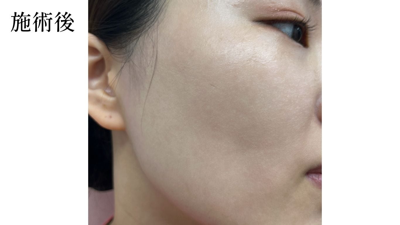 女優水光注射 施術後のツヤ感を示す症例写真