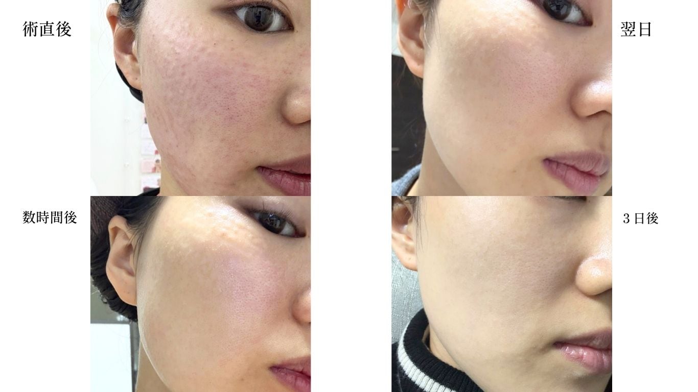 女優水光注射 施術後のツヤ感を示す症例写真