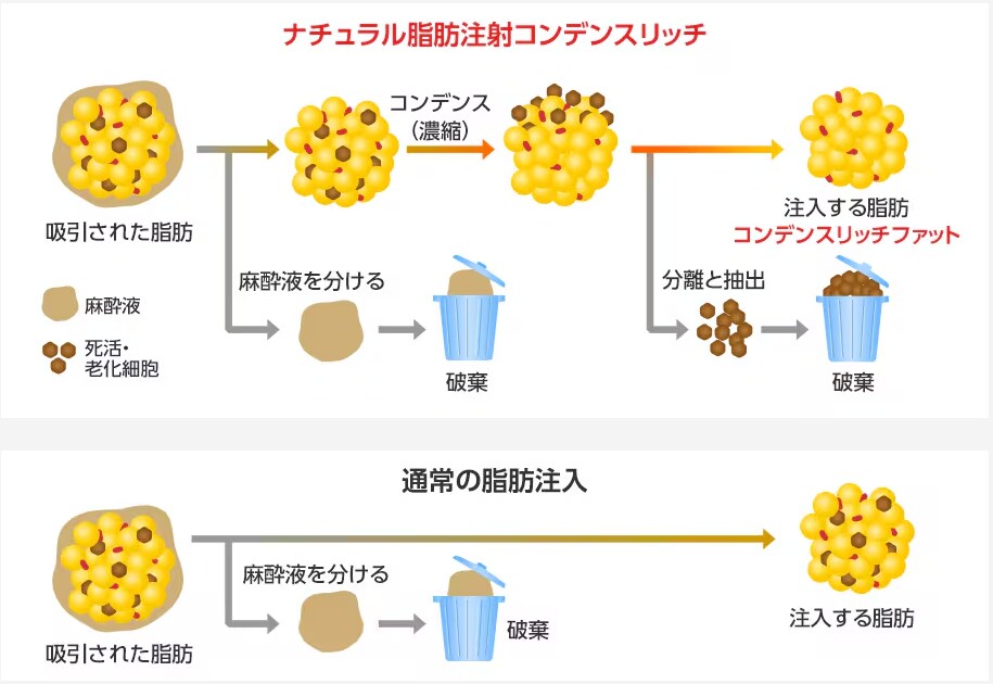 コンデンスリッチ豊胸術の症例写真