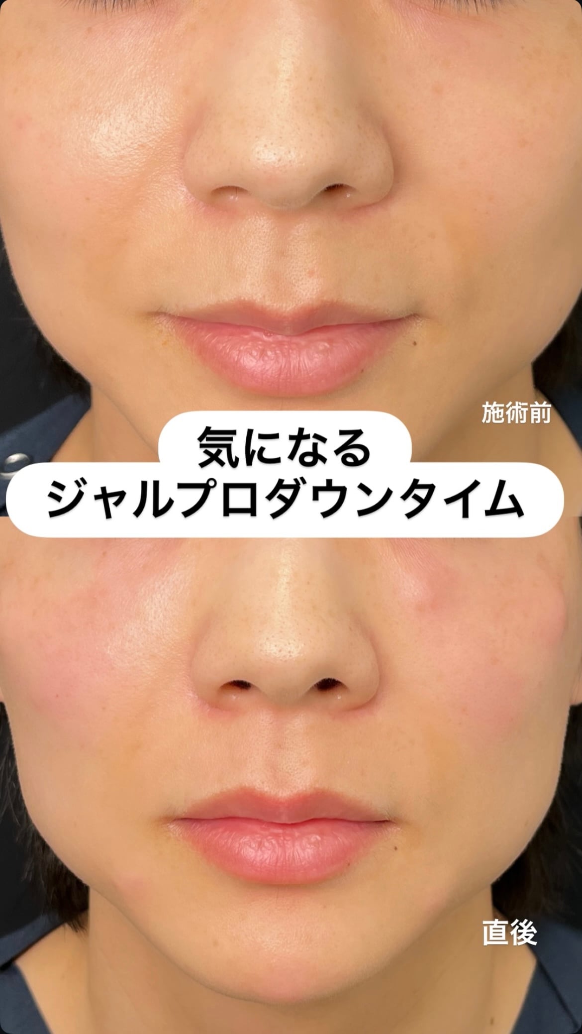 ジャルプロスーパーハイドロ施術前後の症例写真