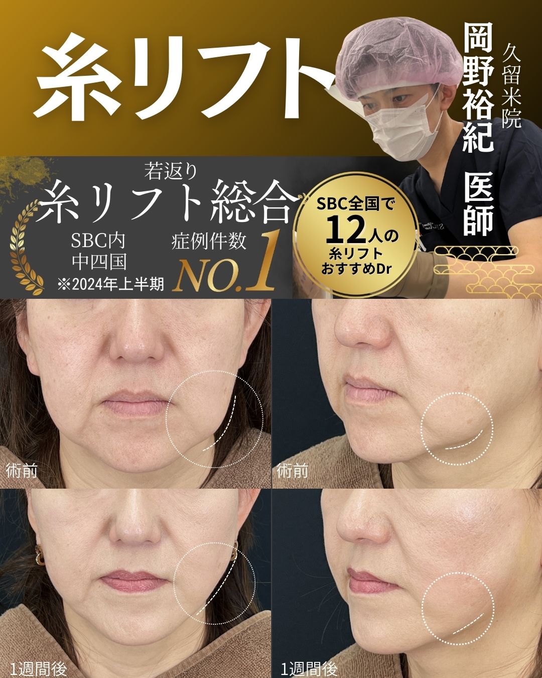 「SBC全国で12人の糸リフトおすすめドクター」に選ばれた岡野院長の若返り術