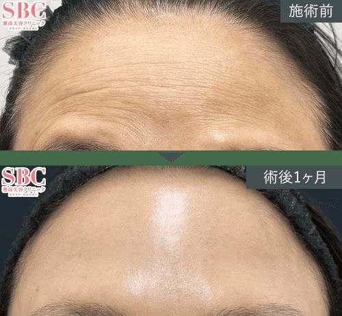 女優注射の画像