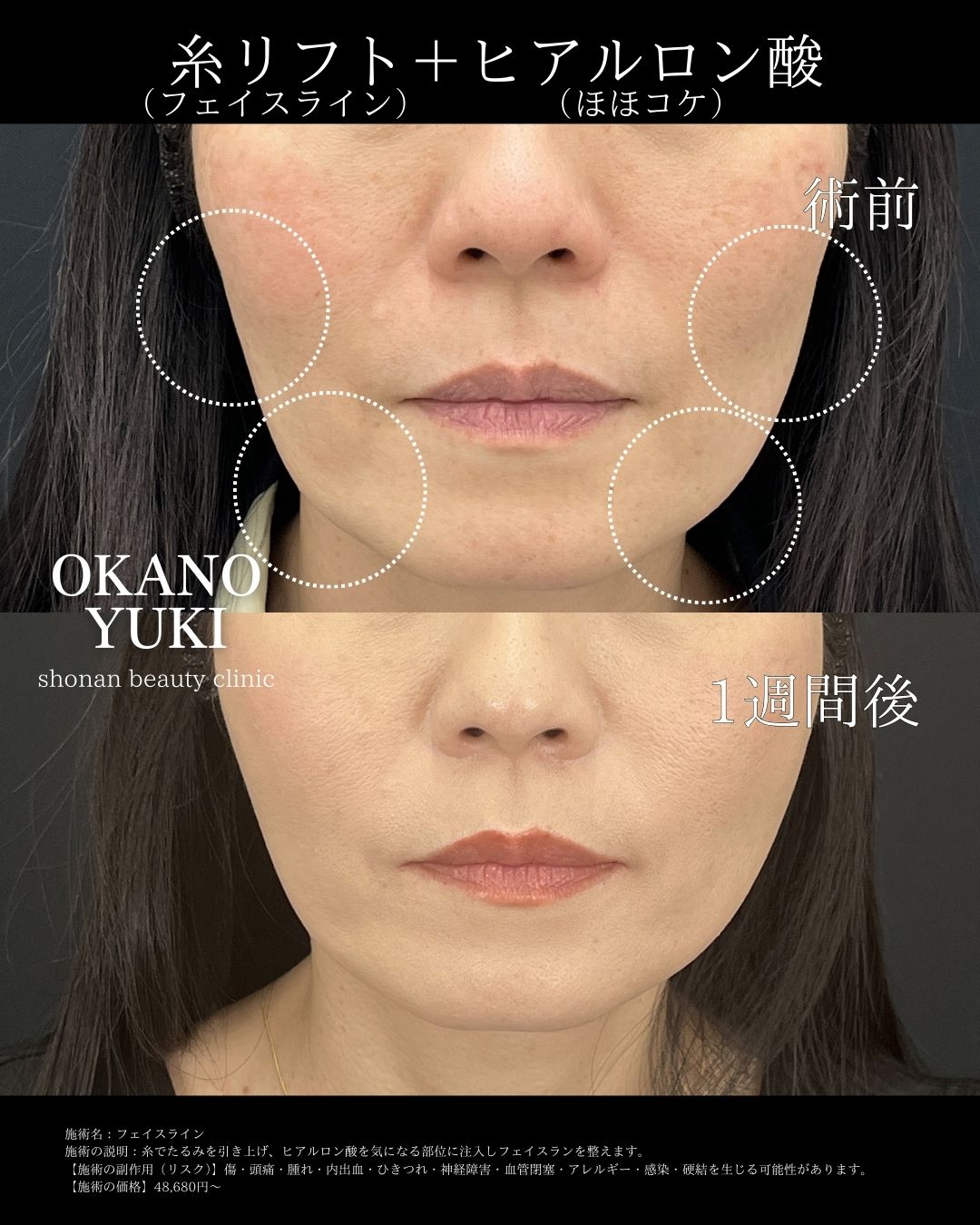糸リフト＋ヒアルロン酸